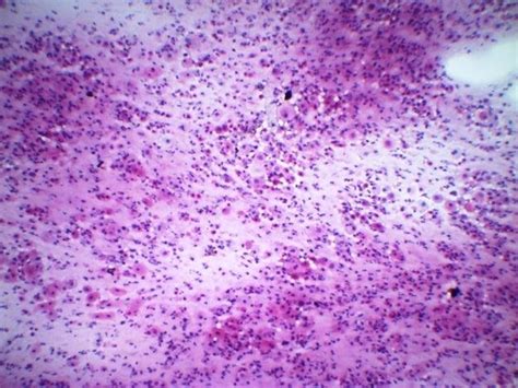 atrophic cell pattern pap.